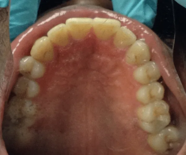 After photo for Clear Aligner case 2 smile transformation