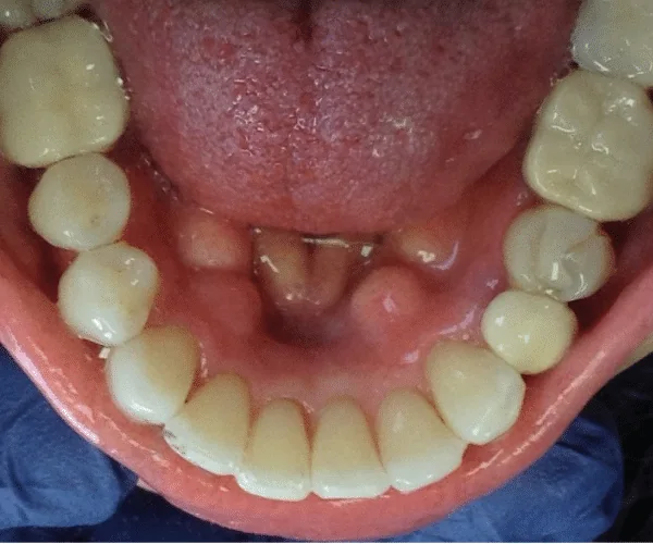 After photo for Clear Aligner case 3 smile transformation