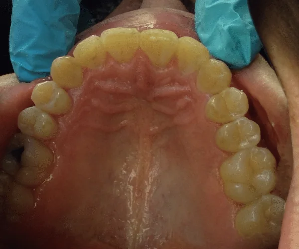After photo for Clear Aligner case 1 smile transformation