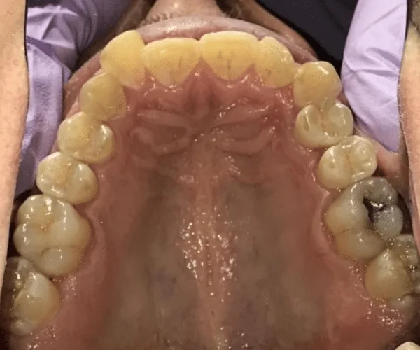 Before photo for Clear Aligner case 1 smile transformation