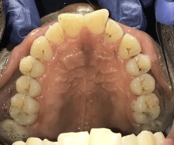 Before photo for Clear Aligner case 2 smile transformation