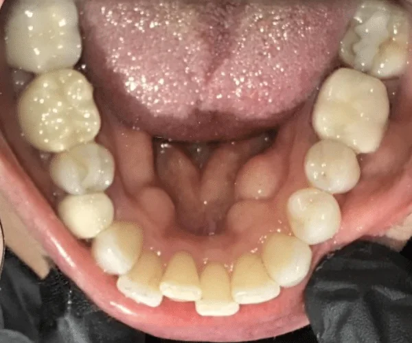 Before photo for Clear Aligner case 3 smile transformation