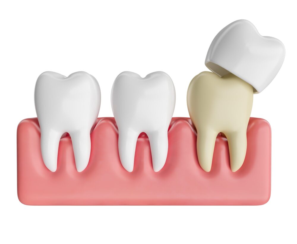 dental crowns roseville