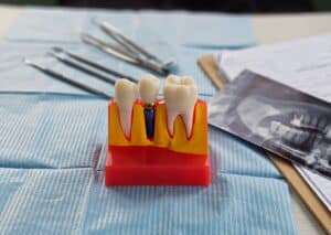 dental implants near roseville