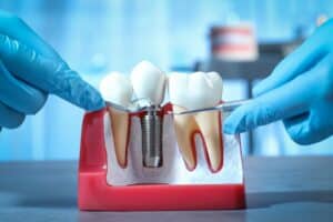 dental implants near me