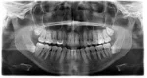 tooth x ray